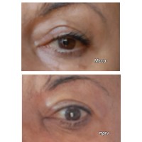 Magnificent Eye Corrector Formula 20ml + Δώρο Reusable Silicone Eye Patches  Magnificent Eye Corrector Formula 20ml + Δώρο Reusable Silicone Eye Patches